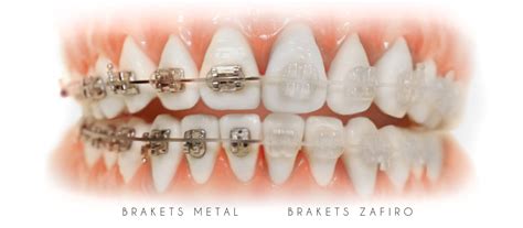 brackets zafiro y metalicos|ortodoncia brackets precio.